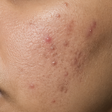 Acne & breakouts