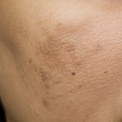 Pigmentation & dullness